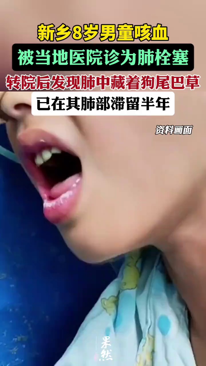 新乡8岁男童咳血在当地被诊肺栓塞，转院后发现是因肺中藏半年狗尾巴草