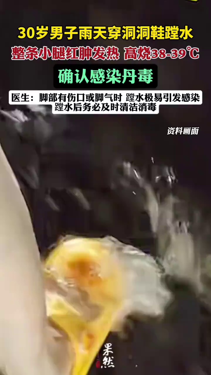 30岁男子雨天穿洞洞鞋蹚水感染丹毒（九派新闻）