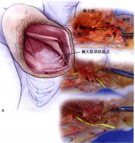 假体隆胸包膜挛缩图片图片