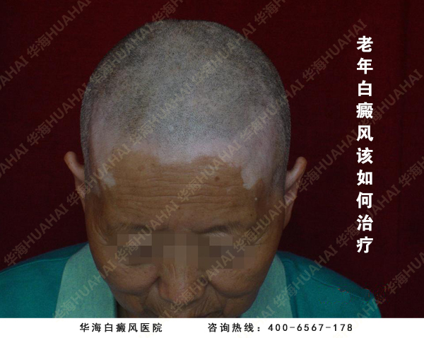 观点:老年白癜风患者,该不该治疗?